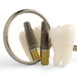 Mituri si adevaruri despre implantul dentar