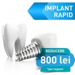 Promotie implant dentar rapid premium – 1000RON REDUCERE 