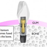 avantajele osteointegrarii implanturilor dentare rapide