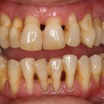 Parodontoza – cauze, simptome, prevenire, tratament boala parodontala