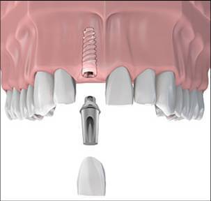 Pasii realizarii implantului dentar