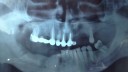 poza-10-proteza-dentara