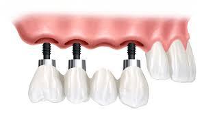 pret-coroana-dentara-pe-implant