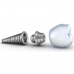 Componentele pretului unui implant dentar. Cat costa implantul dentar?