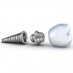 pret implant dentar