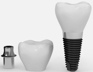 Componente pret implant dentar