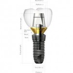 pret implant dentar implantium coreea