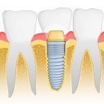 promotii implanturi dentare ieftine cursuri implantologie orala