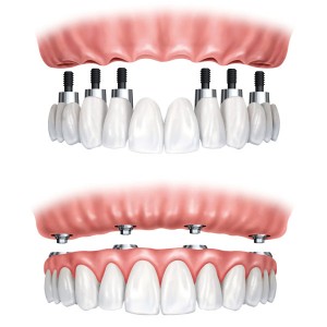 proteza dentara fixa pe implanturi
