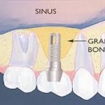 Operatia de sinus lift – ridicarea membranei sinusale prin aditie de os in vederea efectuarii implantului dentar