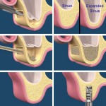 Operatia de sinus lift extern in vederea inserarii implantului dentar