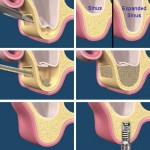 Sinus lift extern - implant dentar