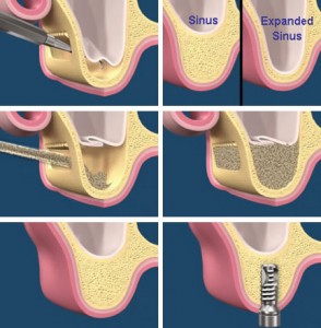 Sinus lift extern - implant dentar