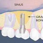 Operatia de sinus lift intern in vederea inserarii implantului dentar