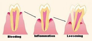 stadiile parodontozei caderea dintilor