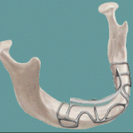 Tipuri de implanturi dentare | Implantul dentar subperiostal
