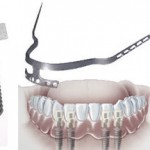Care sunt tipurile de implanturi dentare utilizate in implantologia dentara?