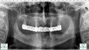 tudor-RX-implant-dentar