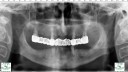 tudor-RX-implant-dentar tudor-RX-implant-dentar