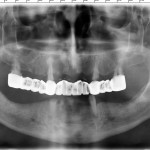 tudor-RX-implant-dentar