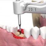 Video cu pasii realizati de specialisti pentru inserarea implantului dentar